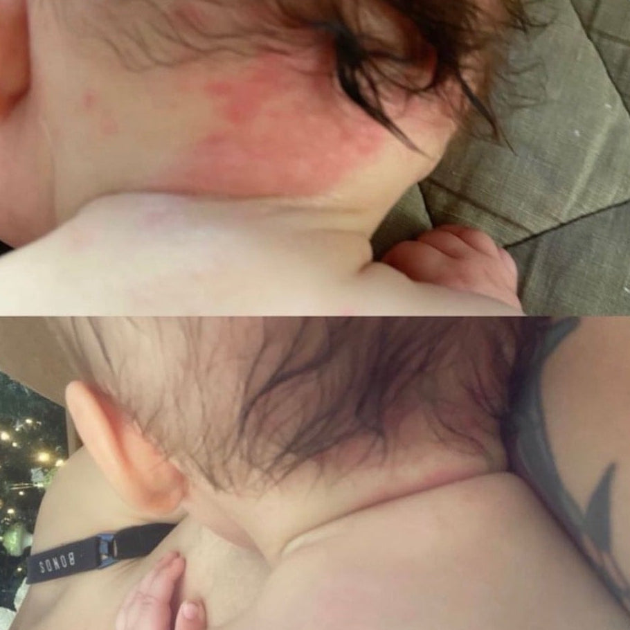 Baby_eczema_calendula_balm.jpg