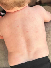 after photo of baby using tallow skin is looking less irritated 
