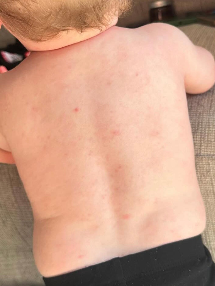 after photo of baby using tallow skin is looking less irritated 