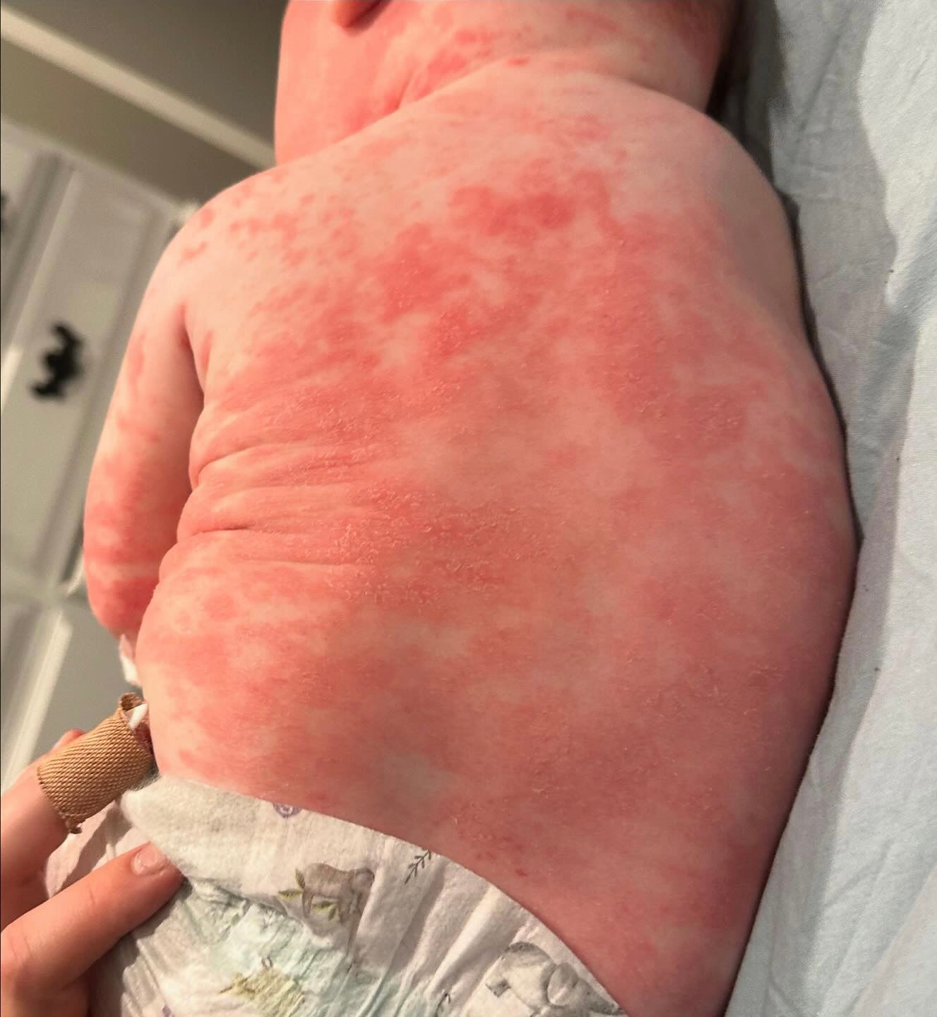a before photo of a baby with irritated skin before using tallow skincare