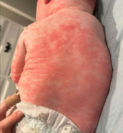 a before photo of a baby with irritated skin before using tallow skincare