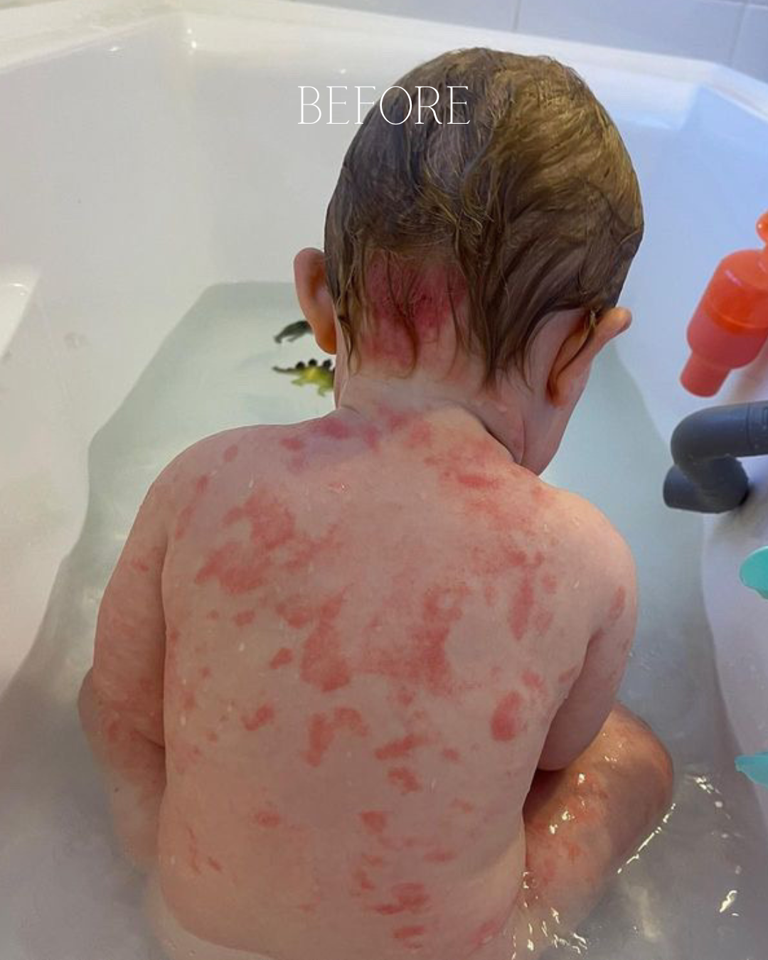 Child in a bathtub with red rash on skin, labeled 'Before' tallow.